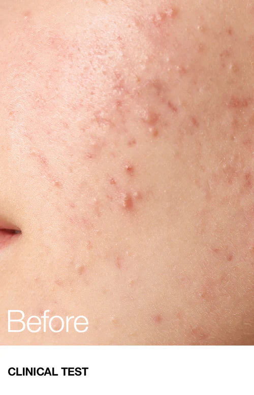 Anua Bha 2% Gentle Exfoliating Toner